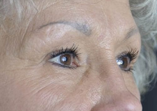 Blepharoplasty Patient 04 - Before 