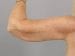 Arm Lift Patient 01 - After Thumbnail 