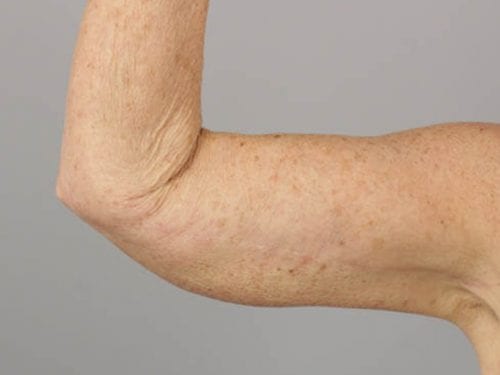 Arm Lift Patient 01 - After Thumbnail