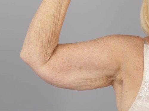 Arm Lift Patient 01 - Before Thumbnail