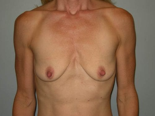 Breast Augmentation Patient 14 - Before 