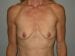 Breast Augmentation Patient 14 - Before Thumbnail 