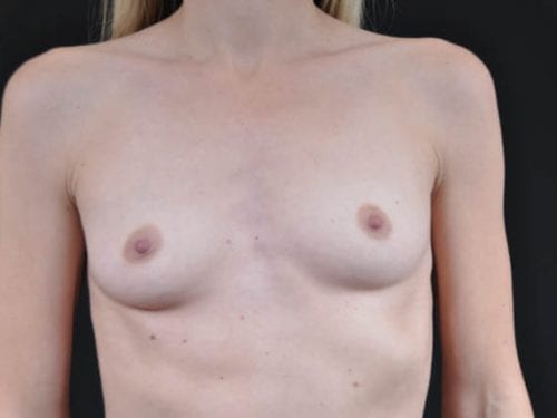 Breast Augmentation Patient 15 - Before Thumbnail