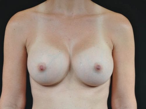 Breast Augmentation Patient 16 - After 