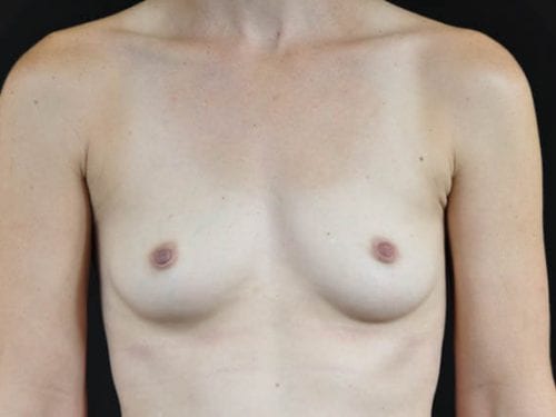 Breast Augmentation Patient 16 - Before 