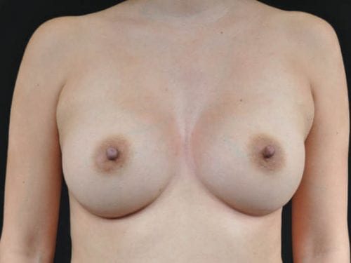 Breast Augmentation Patient 17 - After 
