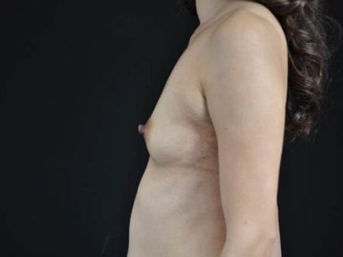 Breast Augmentation Patient 17 - Before 