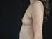 Breast Augmentation Patient 17 - Before Thumbnail 