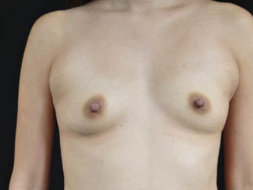 Breast Augmentation Patient 17 - Before 