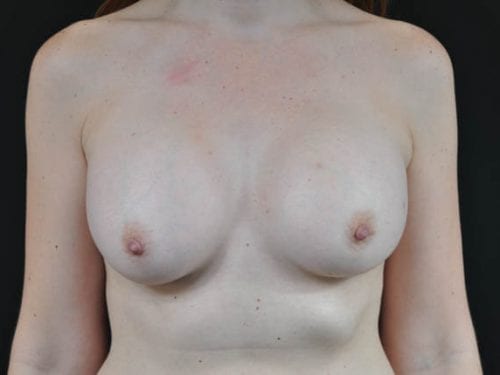 Breast Augmentation Patient 21 - After Thumbnail
