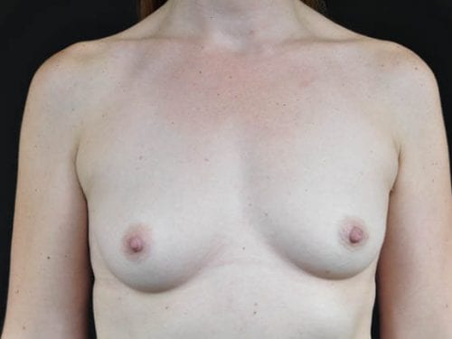 Breast Augmentation Patient 21 - Before Thumbnail