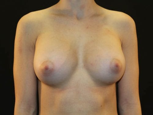Breast Augmentation Patient 22 - After Thumbnail