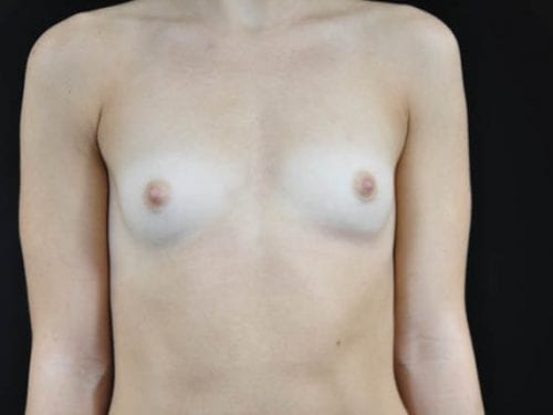 Breast Augmentation Patient 22 - Before Thumbnail