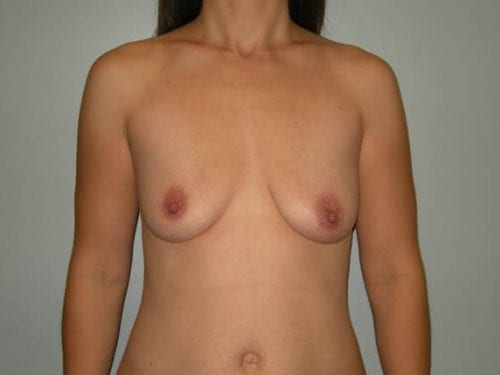 Breast Augmentation Patient 23 - Before Thumbnail