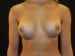Breast Augmentation Patient 24 - After Thumbnail 