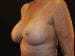 Breast Augmentation Patient 25 - After Thumbnail 