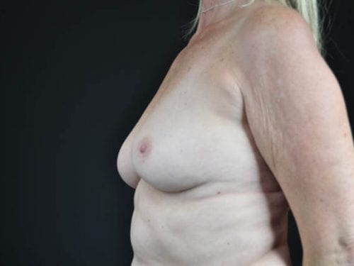Breast Augmentation Patient 25 - Before 