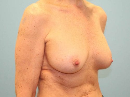 Breast Augmentation Patient 26 - After Thumbnail