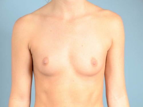 Breast Augmentation Patient 29 - Before 