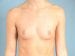 Breast Augmentation Patient 29 - Before Thumbnail 