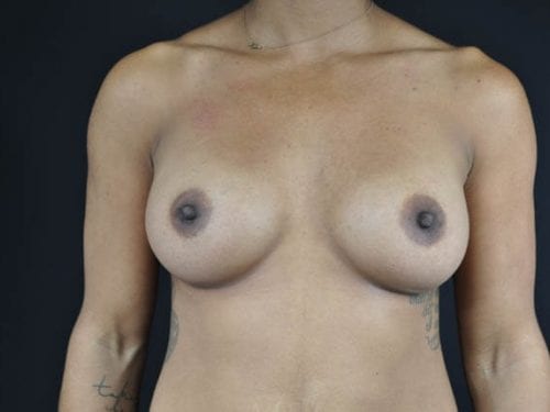 Breast Augmentation Patient 31 - After Thumbnail