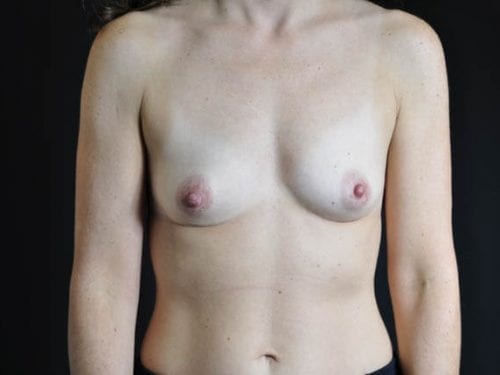 Breast Augmentation Patient 32 - Before 