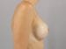 Breast Augmentation Patient 34 - After Thumbnail 
