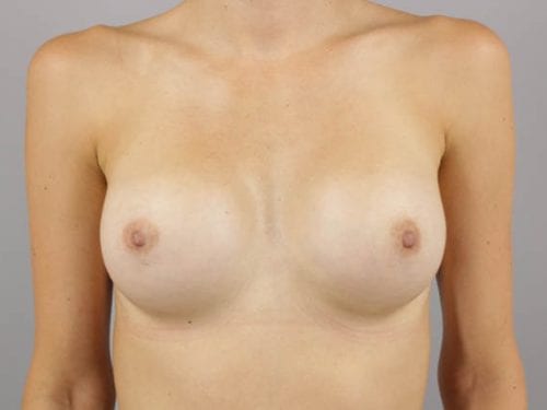 Breast Augmentation Patient 34 - After 