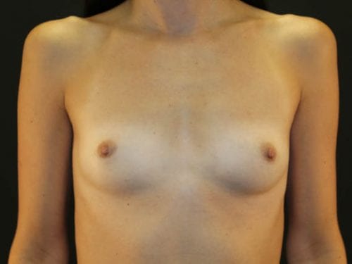 Breast Augmentation Patient 34 - Before 