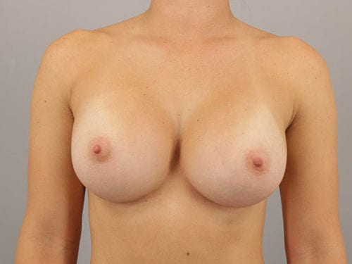 Breast Augmentation Patient 37 - After 