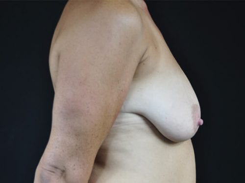 Breast lift with Augmentation Patient 07 - Before 