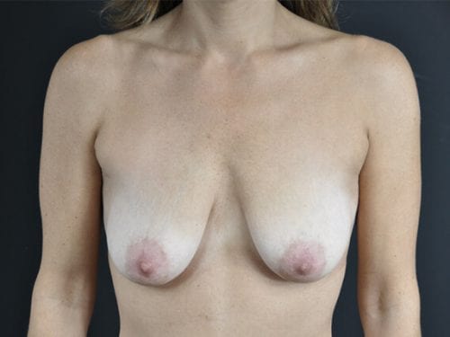 Breast lift with Augmentation Patient 08 - Before Thumbnail