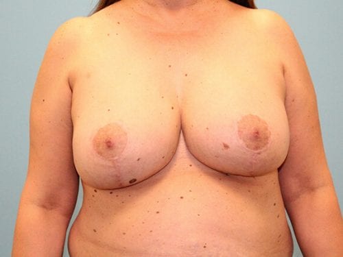 Breast lift with Augmentation Patient 12 - After Thumbnail