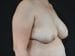 Breast lift with Augmentation Patient 12 - Before Thumbnail 