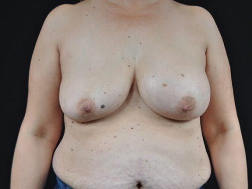 Breast lift with Augmentation Patient 12 - Before Thumbnail