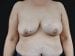 Breast lift with Augmentation Patient 12 - Before Thumbnail 