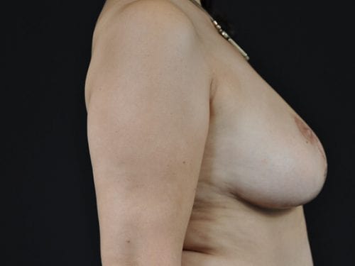 Breast Lift Patient 05 - After 