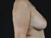 Breast Lift Patient 05 - After Thumbnail 
