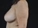 Breast Lift Patient 05 - After Thumbnail 