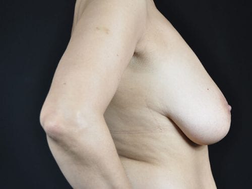 Breast Lift Patient 05 - Before 