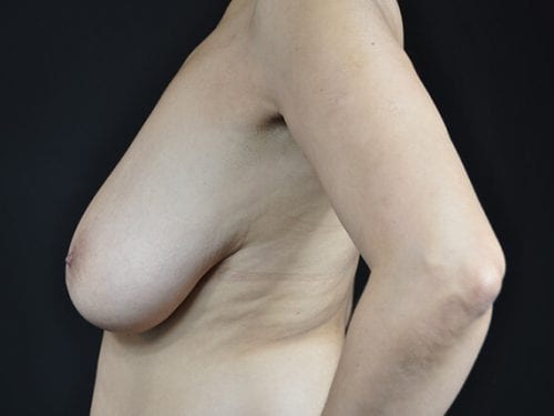 Breast Lift Patient 05 - Before 