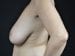 Breast Lift Patient 05 - Before Thumbnail 