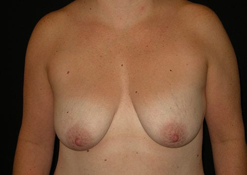 Breast lift with Augmentation Patient 02 - Before Thumbnail