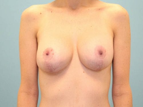 Breast lift with Augmentation Patient 04 - After Thumbnail