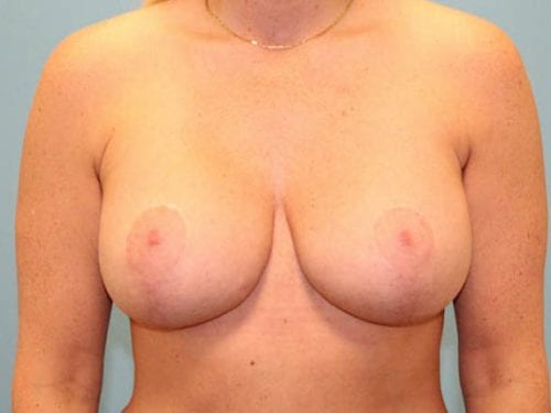 Breast Lift Patient 03 - After Thumbnail
