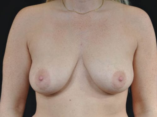 Breast Lift Patient 03 - Before Thumbnail