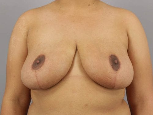Breast Reduction Patient 02 - After 