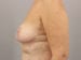 Breast Reduction Patient 08 - After Thumbnail 