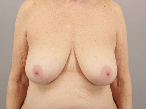 Breast Reduction Patient 08 - Before 