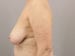 Breast Reduction Patient 08 - Before Thumbnail 